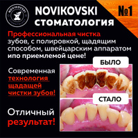Удаление зубного камня при лечении десен
