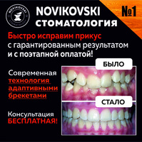 Установка брекетов на зубы на одну челюсть